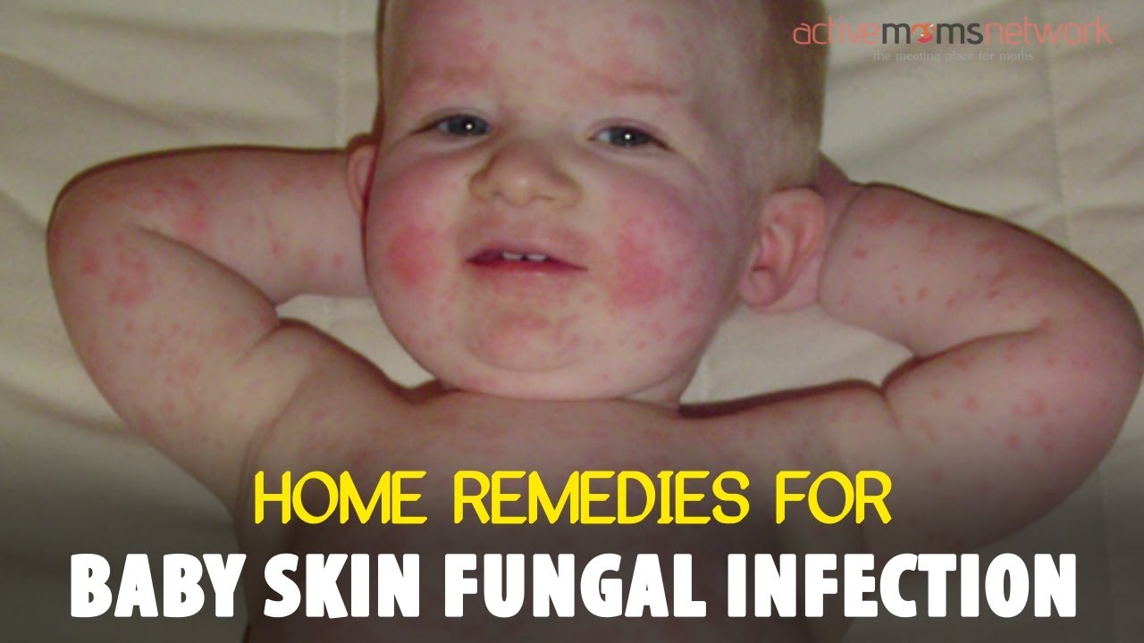 Home Remedies For Baby Skin Fungal Infection | Activemomsnetwork ...