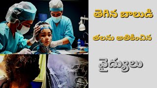 తెగిన బాలుడి తలను అతికించిన వైద్యులు||israel doctors||hannu facts@storys