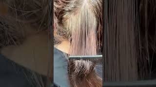 Scalp treatment for severe scalp psoriasis #scalptreatment #scalppsoriasis #scalp