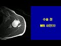 [강동구 정형외과 리더스병원] 상완골 (근위부) 골절 수술사례 (2)