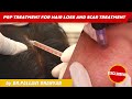 PRP TREATMENT FOR HAIR LOSS AND SCAR TREATMENT|Dr.Pallavi Dhanyan