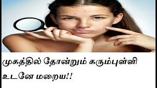 முகத்தில் தோன்றும் கரும்புள்ளி உடனே மறைய!!