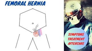 Femoral Hernia Symptoms and Treatment