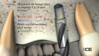 L’implant dentaire ICE |  ALPHA-BIO TEC.