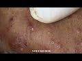 popping tons of blackheads part 192