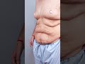 Tummy Tuck Surgery & Gynecomastia Surgery #dezireclinicindia