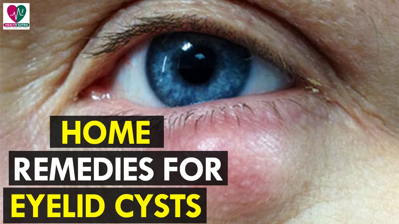 Bumps On Eyeball Causes Types And Treatment