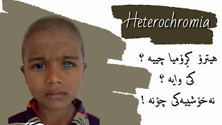 Heterochrimia ..(هیترۆ کرۆمیا) جوت ڕەنگە چاوی کەسەکان هۆکاری چییە