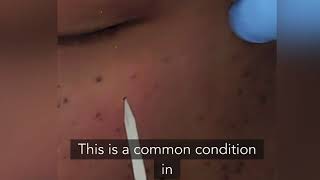 Dermatosis Papulosis Nigrans treatment