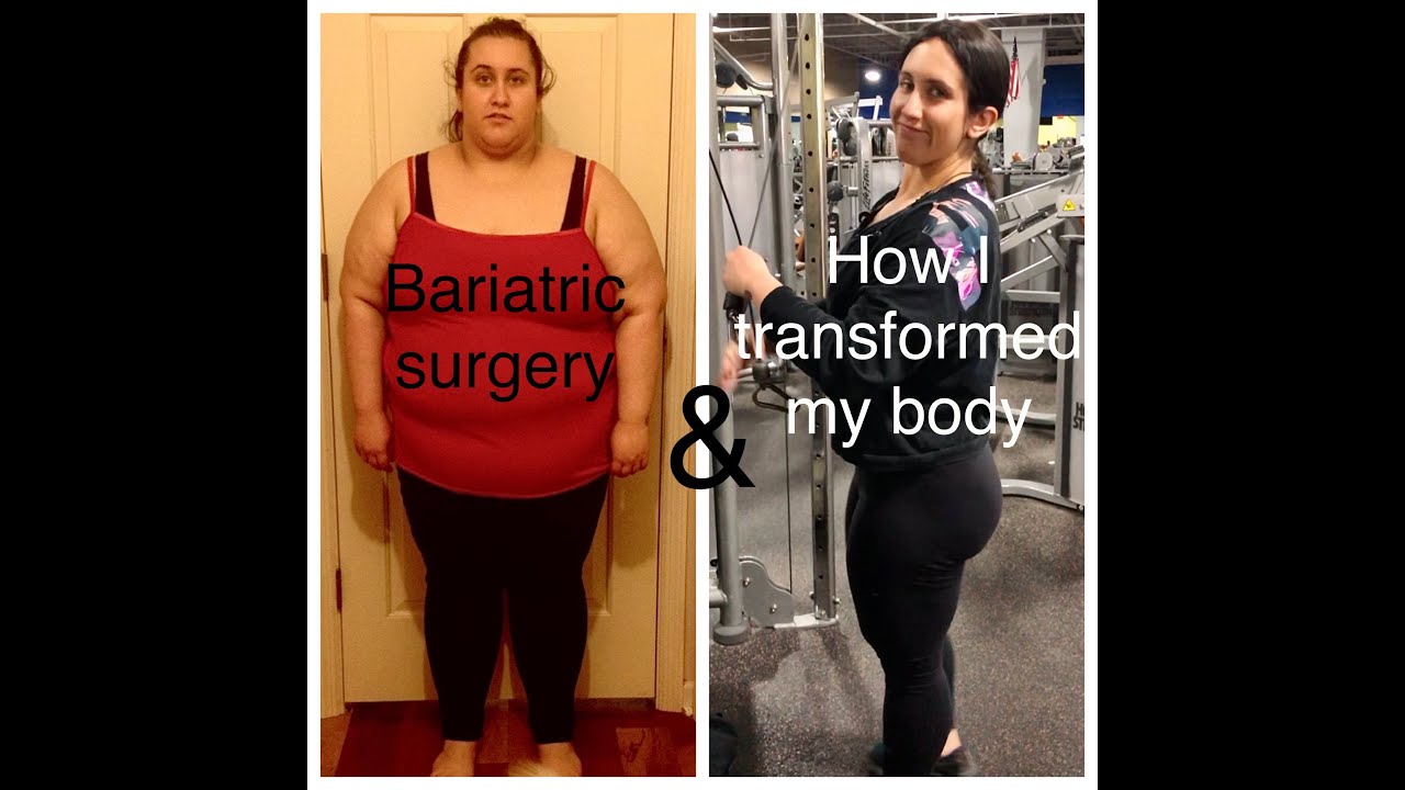 Bariatric Surgery And Exercise Transformation - YouTube