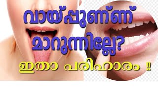 വായ്പ്പുണ്ണിന് ഇതാ ഒറ്റമൂലി!!| Mouth ulcer remedies