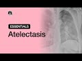 Atelectasis | Chest Radiology Essentials