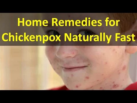 How to Get Rid of Chicken pox Fast! How to Get Rid of Chicken pox Fast!