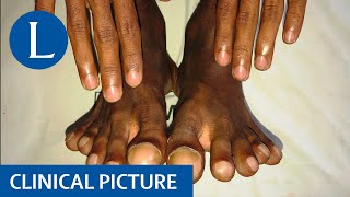 No clubbing in the fingers only in toes: severe pulmonary arterial hypertension