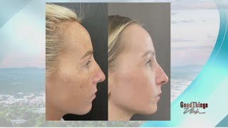 Utah Facial Plastics: Laser resurfacing \u0026 what you need to know