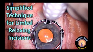 Simplified Technique for LRIs for treating astigmatism