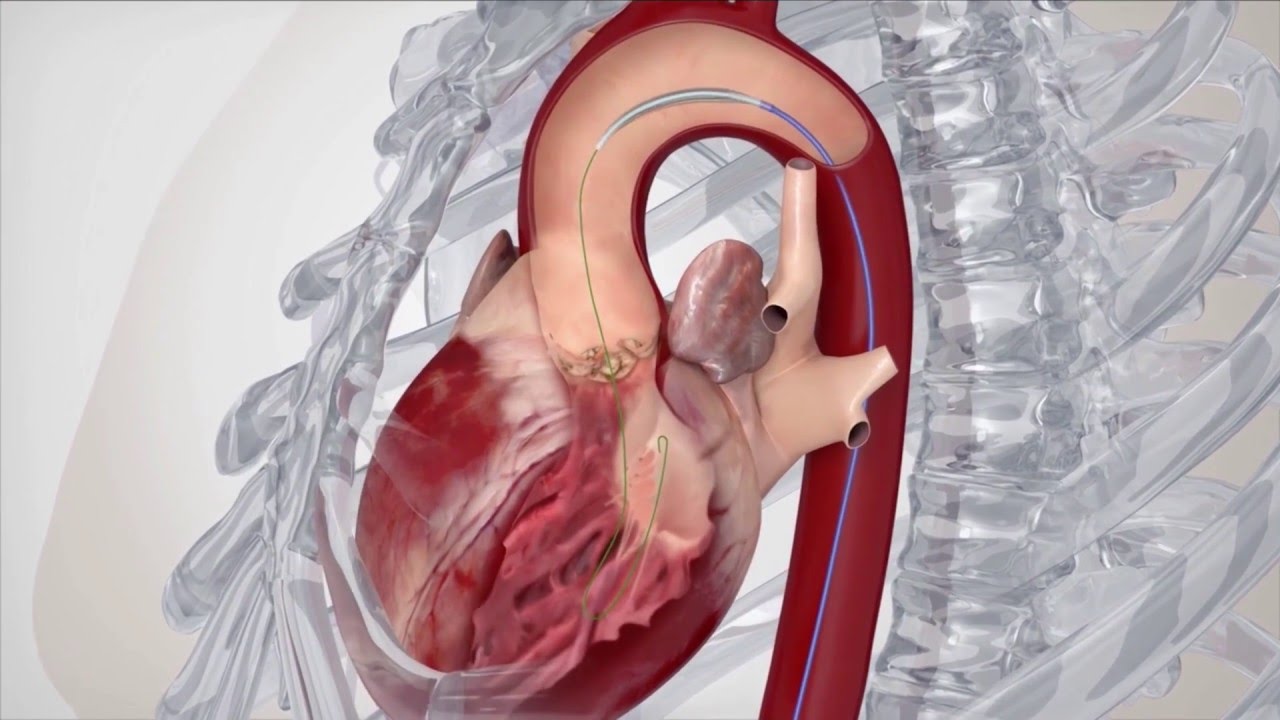 Transcatheter Aortic Valve Replace Tavr Youtube