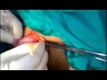 Removal Of Testis In An Adult With Undescended Testis Orchidectomy Removal Of Testis In An Adult With Undescended Testis Orchidectomy