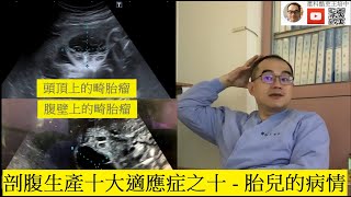 剖腹生產的十大適應症最終篇 -- 胎兒的病情; Part 10: fetal factors。並有精采的圖片介紹極為珍貴的腹裂新生兒治療過程。等您欣賞。