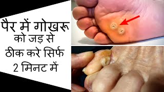 पैर में Foot Corn यानी गोखरू होना आम बात है, इससे कैसे बचें? Foot Corn Home Remedies