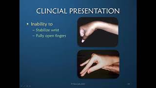 Radial Nerve: Rehabilitation&Orthotic Intervention Part 2 of 5: Clinical Presentation&Rehabilitation
