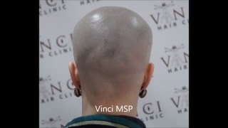 MSP behandeling Alopecia Areata – haaruitval