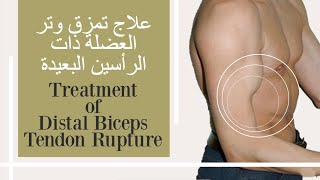 علاج تمزق وتر العضلة ذات الرأسين البعيدة - Treatment of distal biceps tendon rupture