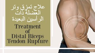 Treatment of distal biceps tendon rupture