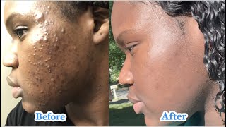 Proactive's Acne Solution Saved My Life!!!!! FR