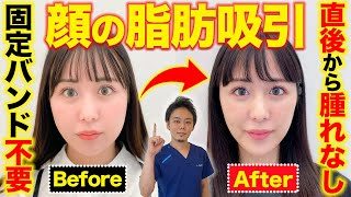 顔のたるみをなくす方法！！フェイスラインの肉を腫れなしで削ぎ落す！！【顔の脂肪吸引　A CLINIC】