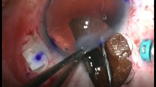 ARTIFICIALIRIS: Combined Implantation with Carlevale IOL, Dr. H. Rouhette, France