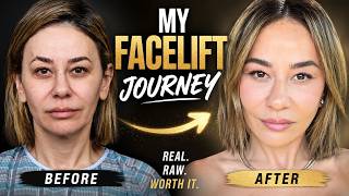 I Secretly Got a Facelift at 44… Here’s the REAL Recovery