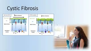 Secondary Chronic Rhinosinusitis