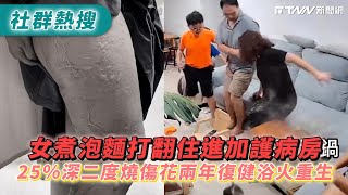 女煮泡麵打翻住進加護病房　25％深二度燒傷花兩年復健浴火重生