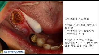 7-16.  치아머리가 적어서 발치하는 경우 (부산 광안리 뉴욕치과)