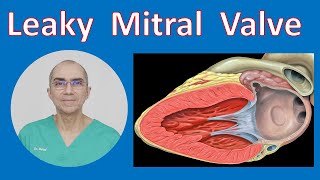 ফুটো Mitral ভালভ - Mitral ভালভ Regurgitation