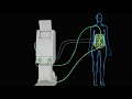 HIPEC (Heated Intraperitoneal Chemotherapy)