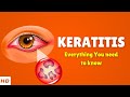 Keratitis – Causes, Types, Signs and Symptoms, Diagnosis & Treatment