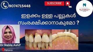 ഇളക്കം ഉള്ള പല്ലുകൾ സംരക്ഷിക്കാനാകുമോ??#Can loose teeth be saved?? #dr. Nabla's