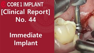 [CYBERMED Clinical Report] #37 immediate implant placement