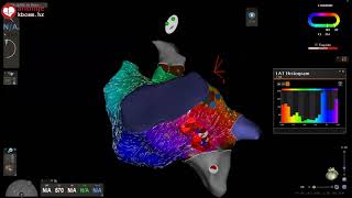 Atrial Flutter Case