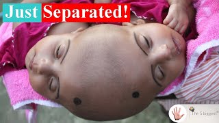 Conjoined Twins Rabia and Rukia's Separation That Lasted 1 Full Year! ~ Body Bizarre!