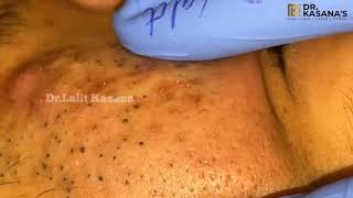 Dr Kasana's 7 Minute Blackhead Removal Challenge