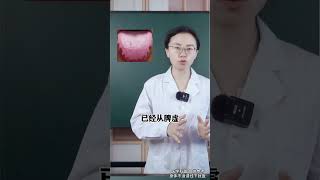 拖成这样的齿痕舌，就不要健脾了，不然就是害了自己 #中医  #科普