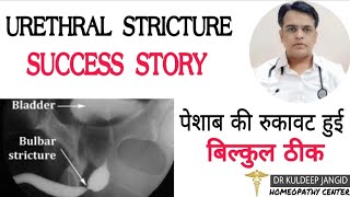 Success story of urethral stricture । पेशाब में रुकावट का सफल इलाज़ । उरेथ्राल स्ट्रिक्टर का इलाज ।