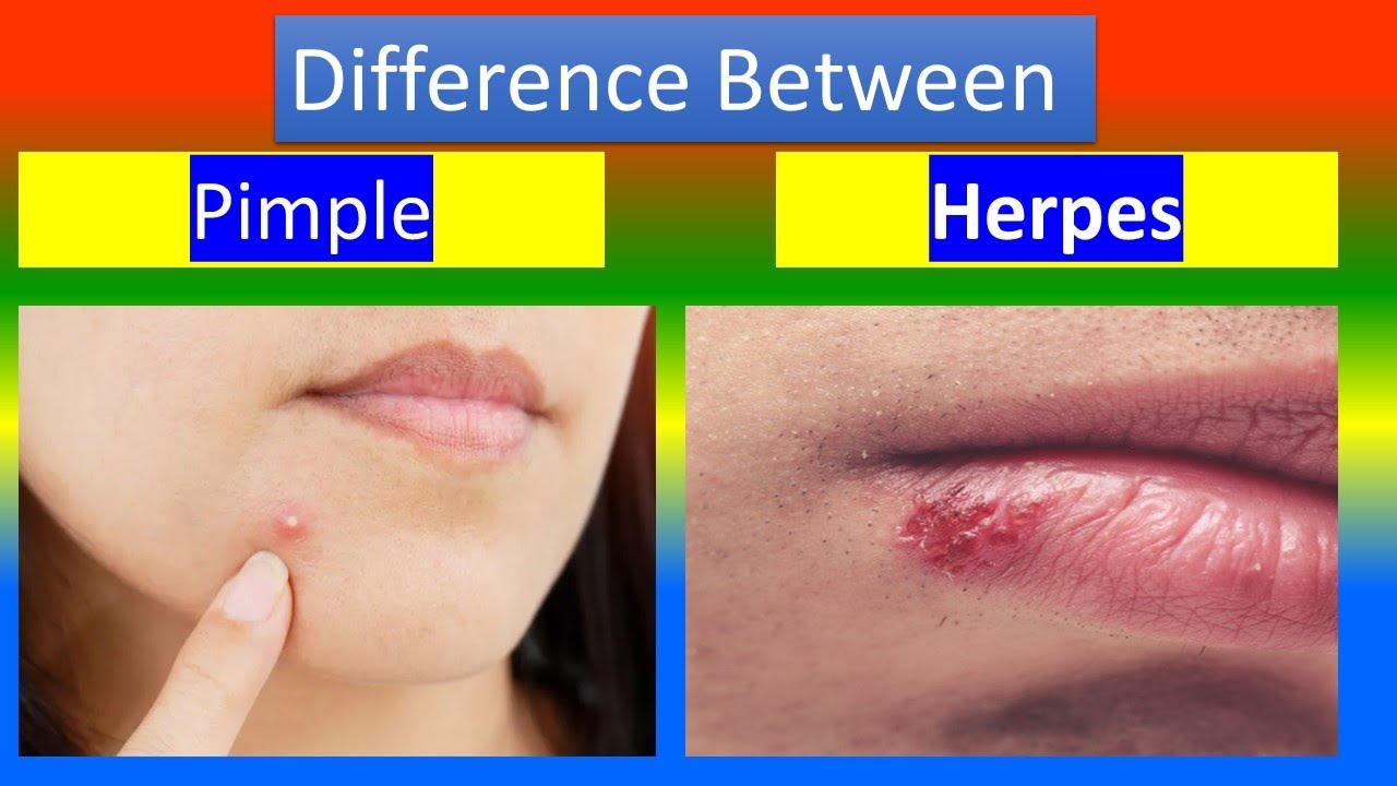 Herpes Vs Pimple