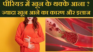 पीरियड्स में खून के थक्के या ज्यादा खून आने को कैसे रोके? Heavy Period