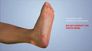 Plantar Fascia Release