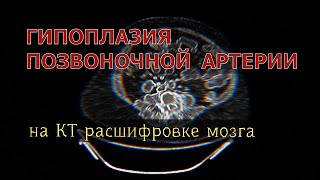 ГИПОПЛАЗИЯ правой ПОЗВОНОЧНОЙ АРТЕРИИ на расшифровке КТ мозга с ангиографией сосудов