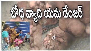 దోమ కుట్టడం వల్ల వచ్చే వ్యాధులు, జాగ్రత్తలు //బోదకాలు ఎలా శుభ్రం చేసుకోవాలి ??  //Dr.kalyan vlogs//